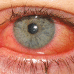 UK winter 2025 respiratory virus overview showing adenovirus alongside flu, RSV, and COVID-19 affecting public health and NHS services